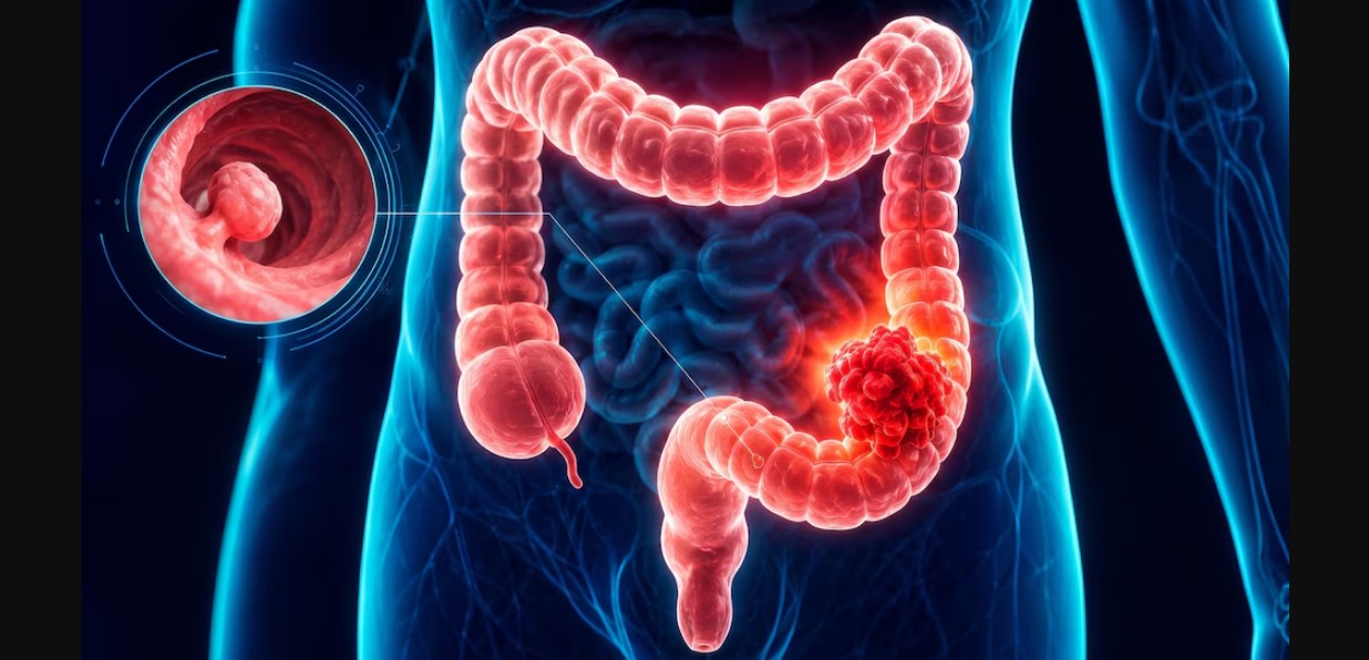 Pólipo en el interior del colon