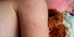Foto: Cortesía Personal de salud aplicando vacuna contra el sarampión.